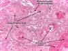 http://www.pathologyatlas.ro/squamous-cell-carcinoma-skin.php