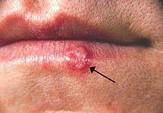 http://en.wikipedia.org/wiki/Herpes_simplex