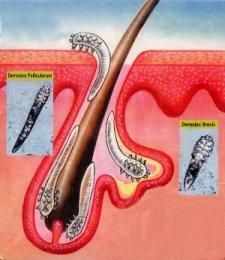 Demodex folliculorum (szörtüszőatka)