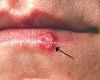 http://en.wikipedia.org/wiki/Herpes_simplex