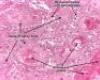 http://www.pathologyatlas.ro/squamous-cell-carcinoma-skin.php